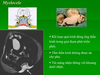 Myelocele
 Rối loạn quá trình đóng ống thần
kinh trong giai đọan phát triển
phôi.
 Tấm thần kinh không được da
che phủ.
 Túi màng nhện thông với khoang
dưới nhện.
 
