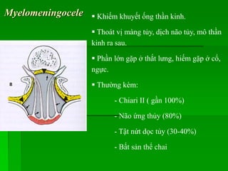 Myelomeningocele  Khiếm khuyết ống thần kinh.
 Thoát vị màng tủy, dịch não tủy, mô thần
kinh ra sau.
 Phần lớn gặp ở thắt lưng, hiếm gặp ở cổ,
ngực.
 Thường kèm:
- Chiari II ( gần 100%)
- Não ứng thủy (80%)
- Tật nứt dọc tủy (30-40%)
- Bất sản thể chai
 