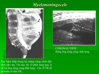 Myelomeningocele
CORONAL VIEW
Rông ống sống cùng, thắt lưng
Tủy bám thấp trong túi màng cứng chứa đầy
dịch não tủy. Túi này lồi về phía lưng qua vị
trí hở ống sống cùng-thắt lưng . Các rễ TK đi
ra trước từ tấm TK.
 