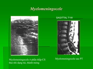 Myelomeningocele
Myelomeningocele ở phần thấp CS
thai nhi dạng túi, thành mỏng
CORONAL SAGITTAL T1W
Myelomeningocele sau PT
 