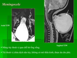 Meningocele
Axial T2W
 Màng tủy thoát vị qua chỗ hở ống sống.
 Túi thoát vị chứa dịch não tủy, không có mô thần kinh, được da che phủ.
Sagittal T2W
 