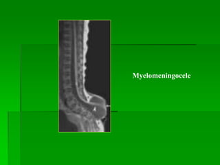 Myelomeningocele
 