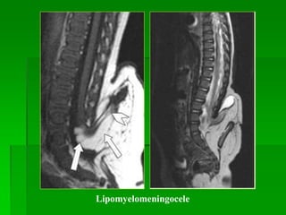 Lipomyelomeningocele
 
