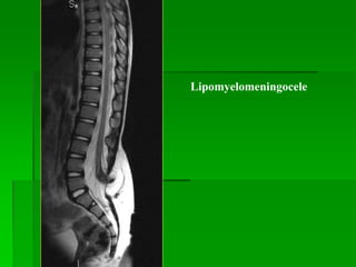 Lipomyelomeningocele
 