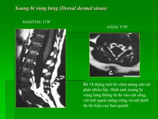 SAGITTAL T1W
AXIAL T1W
Bé 18 tháng tuồi bị viêm màng não tái
phát nhiều lần. Hình ảnh xoang bì
vùng lưng thông từ da vào cột sống,
với mỡ ngoài màng cứng và mỡ dưới
da tín hiệu cao bao quanh.
Xoang bì vùng lưng (Dorsal dermal sinus)
 