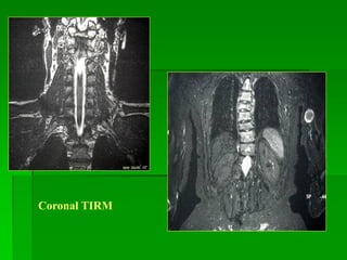 Coronal TIRM
 