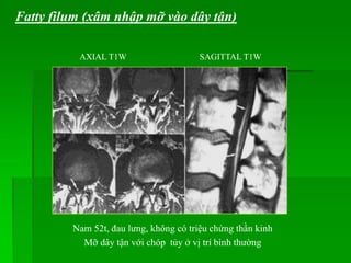 AXIAL T1W SAGITTAL T1W
Nam 52t, đau lưng, không có triệu chứng thần kinh
Mỡ dây tận với chóp tủy ở vị trí bình thường
Fatty filum (xâm nhập mỡ vào dây tận)
 