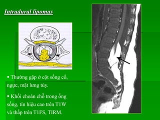 Intradural lipomas
 Thường gặp ở cột sống cổ,
ngực, mặt lưng tủy.
 Khối choán chỗ trong ống
sống, tín hiệu cao trên T1W
và thấp trên T1FS, TIRM.
 