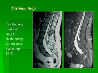 Tủy bám thấp
Tủy tận cùng
dưới thân
sống L2
(bình thường
tủy tận cùng
ngang mức
L1-2).
 