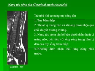 Sagittal T1W
Trẻ nhũ nhi có nang tủy sống tận
1. Tủy bám thấp
2. Thoát vị màng não và khoang dưới nhện qua
chỗ khuyết xương ở lưng.
3. Nang tủy sống tận lồi bên dưới phần thoát vị
màng não, liên tiếp với ống sống trung tâm bị
dãn của tủy sống bám thấp.
4. Khoang dưới nhện thắt lưng cùng phía
trước.
Nang tủy sống tận (Terminal myelocystocele)
 