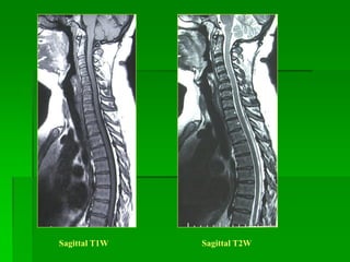 Sagittal T1W Sagittal T2W
 