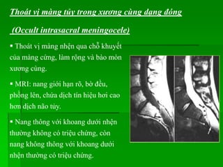 Thoát vị màng nhện qua chỗ khuyết
của màng cứng, làm rộng và bào mòn
xương cùng.
 MRI: nang giới hạn rõ, bờ đều,
phồng lên, chứa dịch tín hiệu hơi cao
hơn dịch não tủy.
 Nang thông với khoang dưới nhện
thường không có triệu chứng, còn
nang không thông với khoang dưới
nhện thường có triệu chứng.
Thoát vị màng tủy trong xương cùng dạng đóng
(Occult intrasacral meningocele)
 
