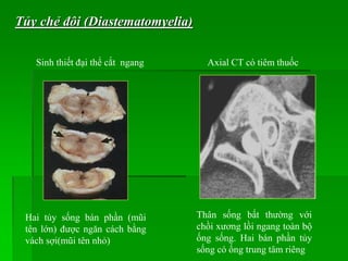 Hai tủy sống bán phần (mũi
tên lớn) được ngăn cách bằng
vách sợi(mũi tên nhỏ)
Axial CT có tiêm thuốcSinh thiết đại thể cắt ngang
Thân sống bất thường với
chồi xương lồi ngang toàn bộ
ống sống. Hai bán phần tủy
sống có ống trung tâm riêng
Tủy chẻ đôi (Diastematomyelia)
 