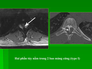 Hai phần tủy nằm trong 2 bao màng cứng (type I)
 