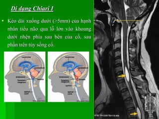  Kéo dài xuống dưới (>5mm) của hạnh
nhân tiểu não qua lỗ lớn vào khoang
dưới nhện phía sau bên của cổ, sau
phần trên tủy sống cổ.
Dị dạng Chiari I
 