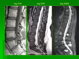 Sag T1W Sag T2W Sag TIRM
 
