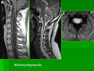 Hydrosyringomyelia
 