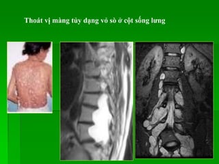 Thoát vị màng tủy dạng vỏ sò ở cột sống lƣng
 