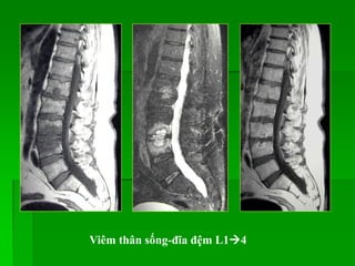 Viêm thân sống-đĩa đệm L14
 
