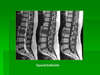Spondylodiskitis
 