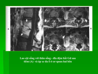 Lao cột sống với thân sống - đĩa đệm bắt Gd sau
tiêm (A) và áp xe đa ổ ở cơ spoas hai bên
 