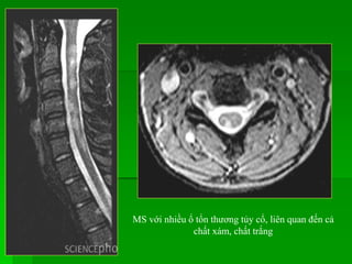 MS với nhiều ổ tổn thương tủy cổ, liên quan đến cả
chất xám, chất trắng
 