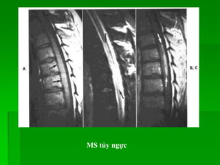 MS tủy ngực
 