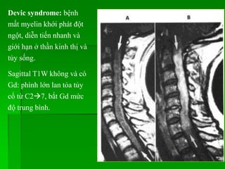 Devic syndrome: bệnh
mất myelin khới phát đột
ngột, diễn tiến nhanh và
giới hạn ở thần kinh thị và
tủy sống.
Sagittal T1W không và có
Gd: phình lớn lan tỏa tủy
cổ từ C27, bắt Gd mức
độ trung bình.
 