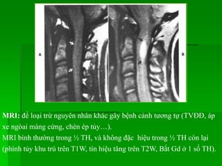 MRI: để loại trừ nguyên nhân khác gây bệnh cảnh tương tự (TVĐĐ, áp
xe ngòai màng cứng, chèn ép tủy…).
MRI bình thường trong ½ TH, và không đặc hiệu trong ½ TH còn lại
(phình tủy khu trú trên T1W, tín hiệu tăng trên T2W, Bắt Gd ở 1 số TH).
 