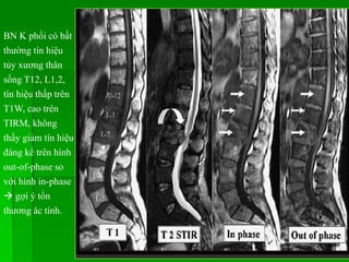 BN K phổi có bất
thường tín hiệu
tủy xương thân
sống T12, L1,2,
tín hiệu thấp trên
T1W, cao trên
TIRM, không
thấy giảm tín hiệu
đáng kể trên hình
out-of-phase so
với hình in-phase
 gợi ý tổn
thương ác tính.
 