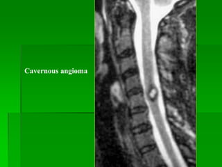 Cavernous angioma
 