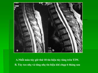 A.Nhồi máu tủy giờ thứ 18 tín hiệu tủy tăng trên T2W.
B. Tủy teo nhẹ và tăng nhẹ tín hiệu khi chụp 6 tháng sau
 