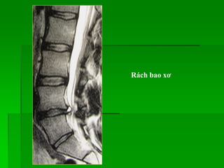 Rách bao xơ
 