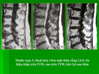 Modic type I: thoái hóa viêm mặt thân sống L4,5, tín
hiệu thấp trên T1W, cao trên T2W, bắt Gd sau tiêm
 