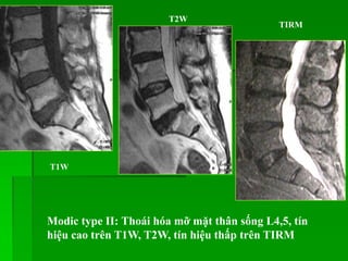Modic type II: Thoái hóa mỡ mặt thân sống L4,5, tín
hiệu cao trên T1W, T2W, tín hiệu thấp trên TIRM
T1W
T2W
TIRM
 