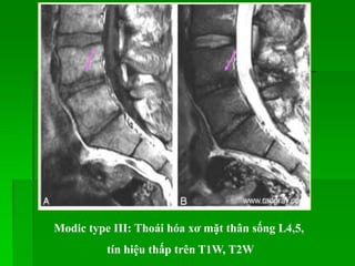 Modic type III: Thoái hóa xơ mặt thân sống L4,5,
tín hiệu thấp trên T1W, T2W
 