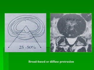 Broad-based or diffuse protrusion
 