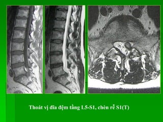 Thoát vị đĩa đệm tầng L5-S1, chèn rễ S1(T)
 