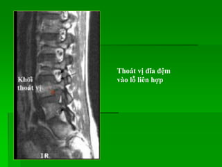 Thoát vị đĩa đệm
vào lỗ liên hợp
 