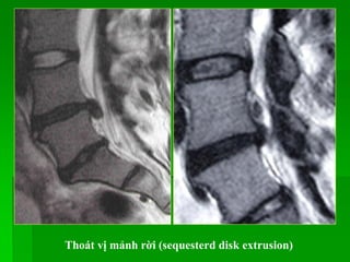 Thoát vị mảnh rời (sequesterd disk extrusion)
 