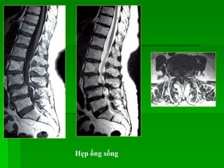 Hẹp ống sống
 