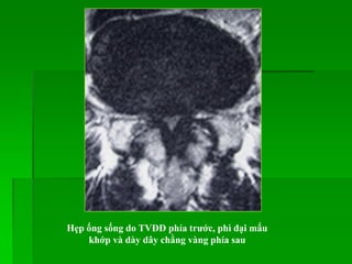 Hẹp ống sống do TVĐĐ phía trƣớc, phì đại mấu
khớp và dày dây chằng vàng phía sau
 