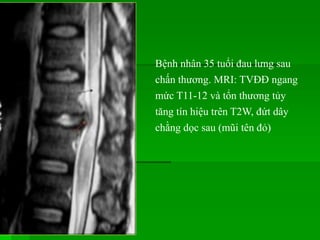 Bệnh nhân 35 tuổi đau lưng sau
chấn thương. MRI: TVĐĐ ngang
mức T11-12 và tổn thương tủy
tăng tín hiệu trên T2W, đứt dây
chằng dọc sau (mũi tên đỏ)
 