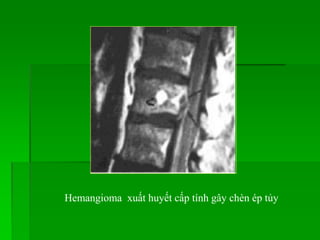 Hemangioma xuất huyết cấp tính gây chèn ép tủy
 