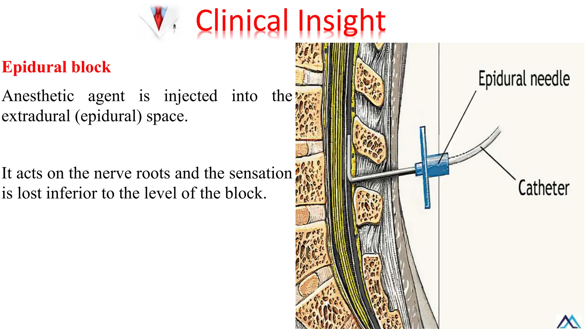 Epidural block
Anesthetic agent is injected into the
extradural (epidural) space.
It acts on the nerve roots and the sensation
is lost inferior to the level of the block.
Clinical Insight
 