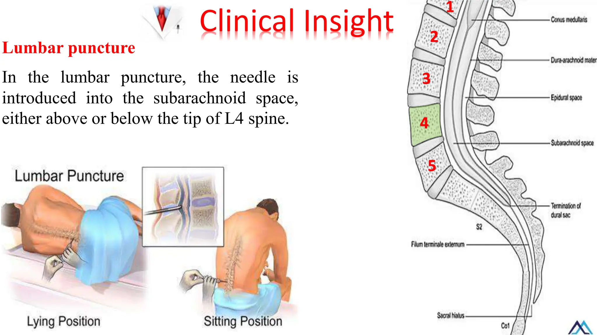 Lumbar puncture
In the lumbar puncture, the needle is
introduced into the subarachnoid space,
either above or below the tip of L4 spine.
Clinical Insight
1
2
3
5
4
 