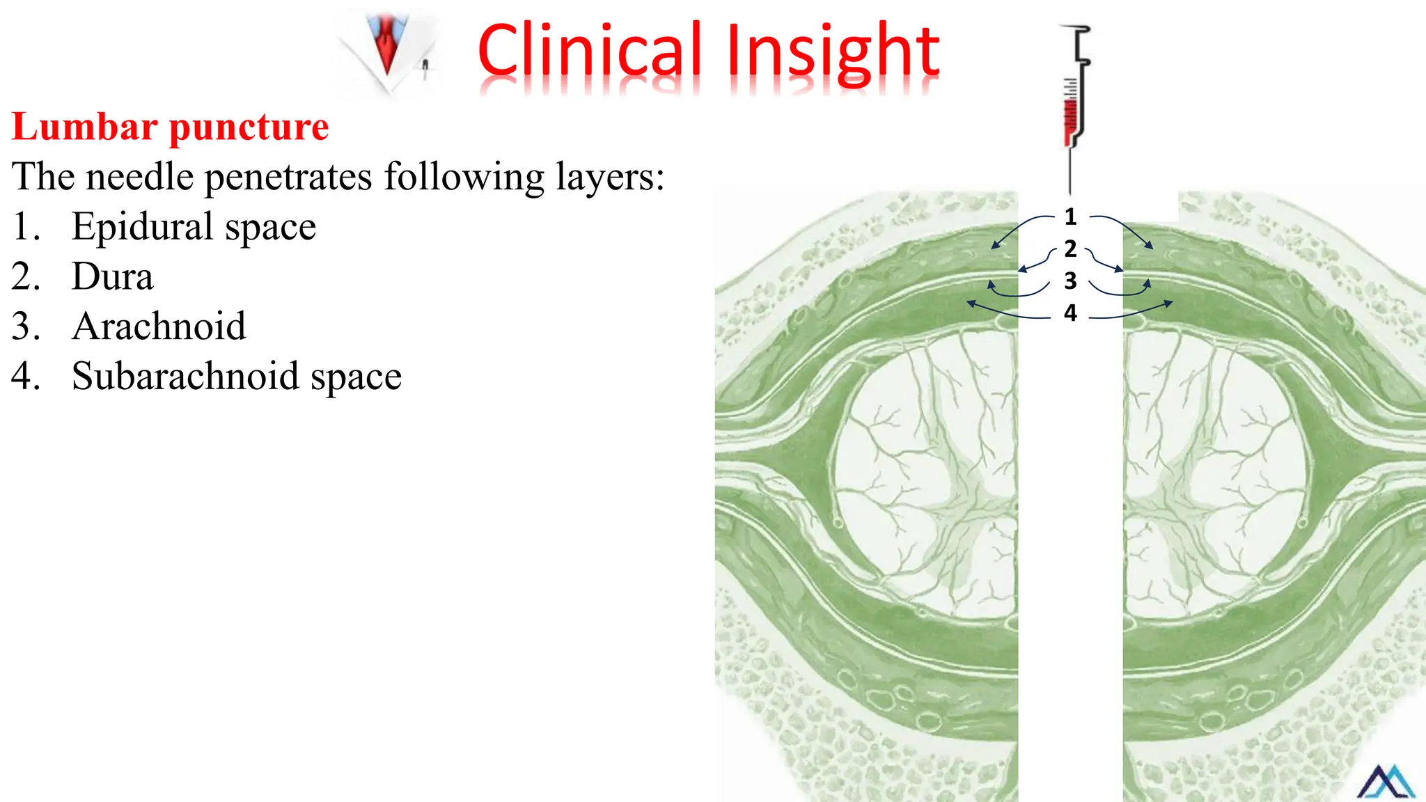 Lumbar puncture
The needle penetrates following layers:
1. Epidural space
2. Dura
3. Arachnoid
4. Subarachnoid space
Clinical Insight
1
2
3
4
 