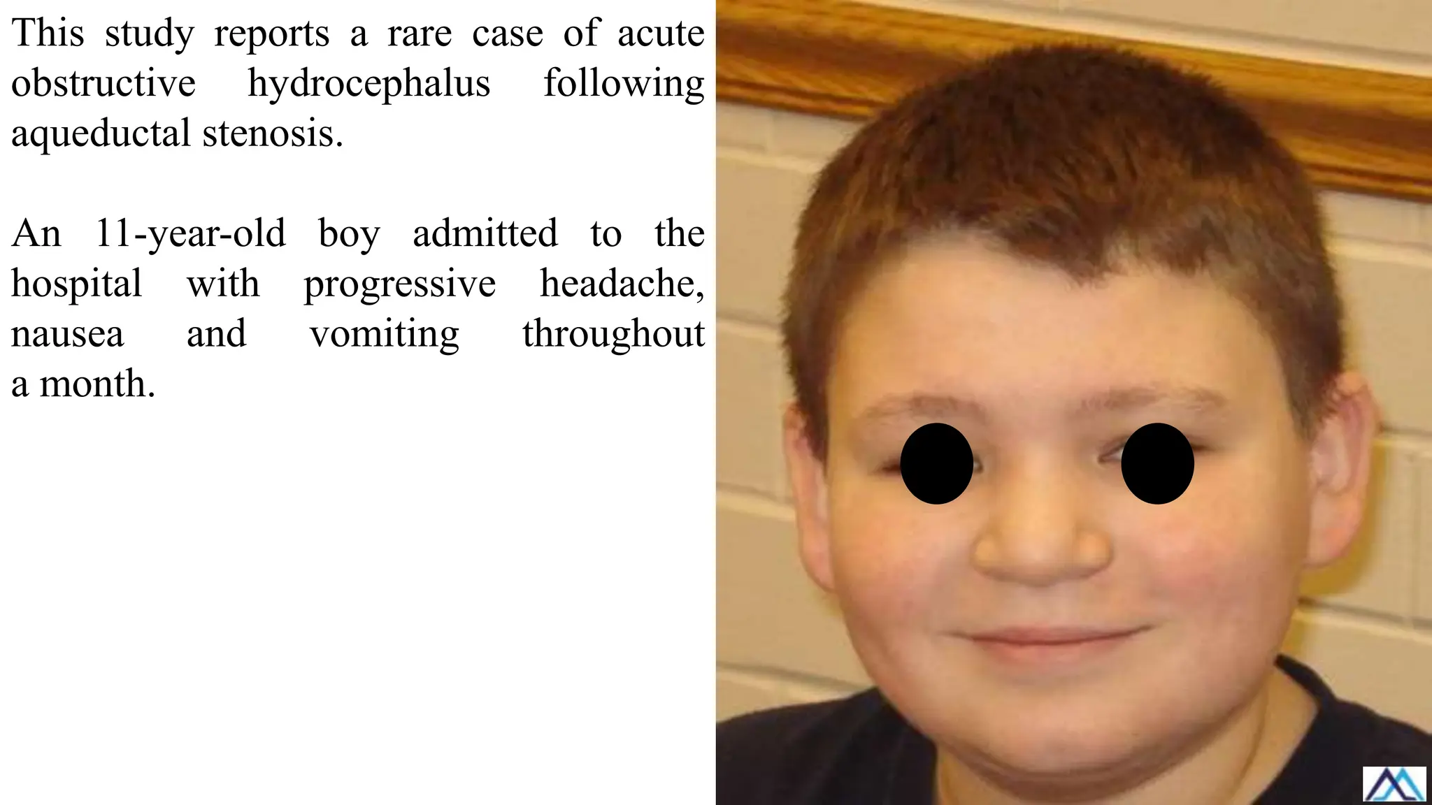 This study reports a rare case of acute
obstructive hydrocephalus following
aqueductal stenosis.
An 11-year-old boy admitted to the
hospital with progressive headache,
nausea and vomiting throughout
a month.
 