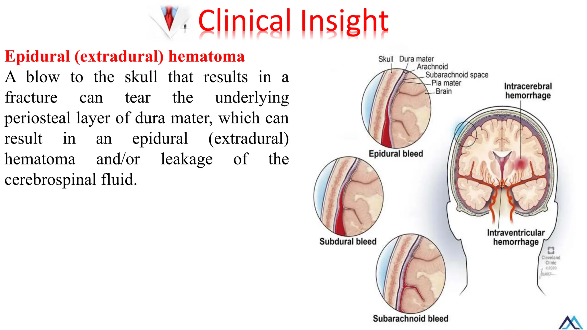 Epidural (extradural) hematoma
A blow to the skull that results in a
fracture can tear the underlying
periosteal layer of dura mater, which can
result in an epidural (extradural)
hematoma and/or leakage of the
cerebrospinal fluid.
Clinical Insight
 