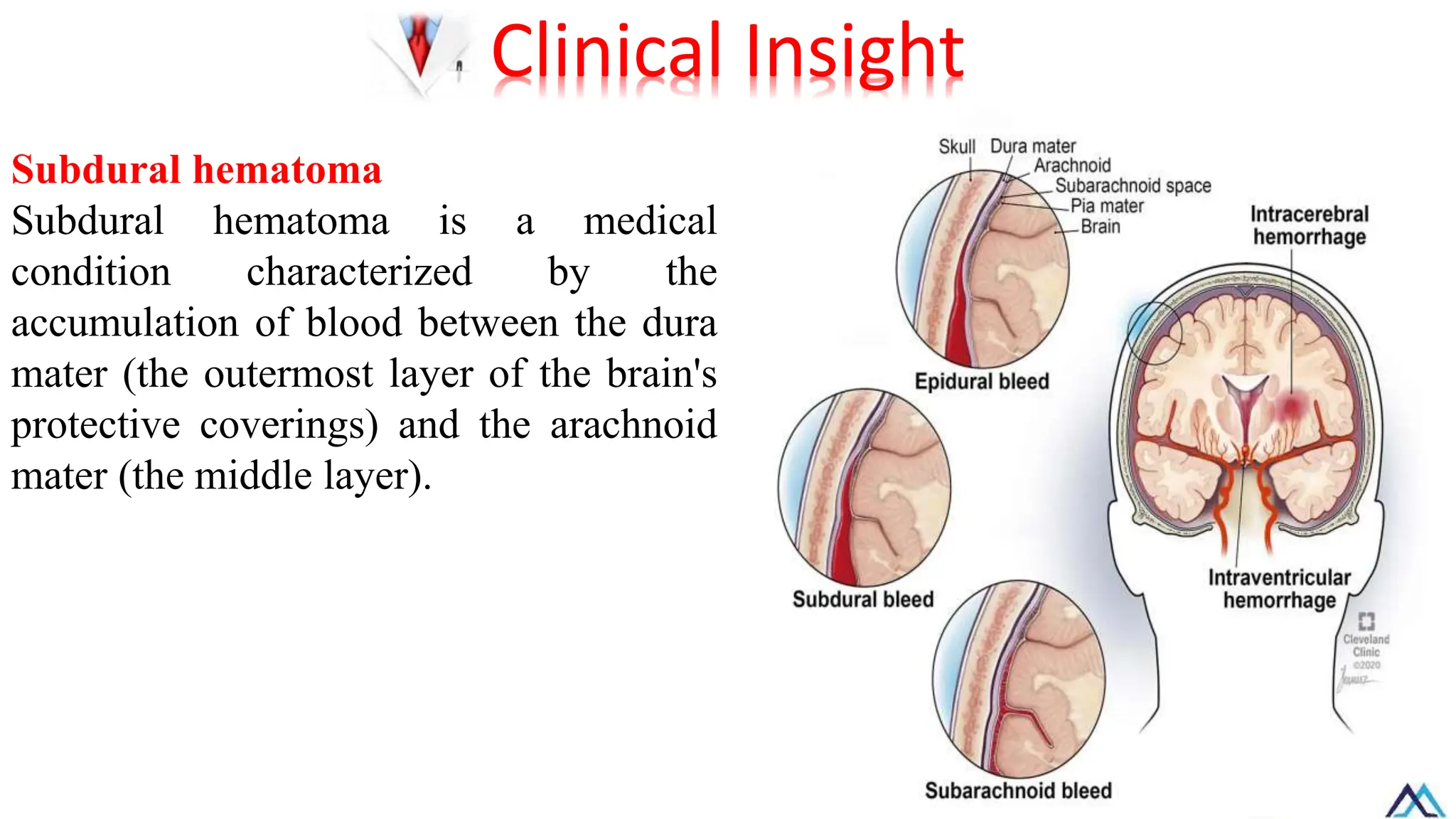 Subdural hematoma
Subdural hematoma is a medical
condition characterized by the
accumulation of blood between the dura
mater (the outermost layer of the brain's
protective coverings) and the arachnoid
mater (the middle layer).
Clinical Insight
 